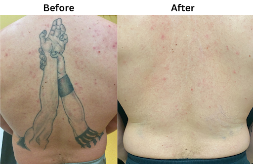 Explore cape verde tattoo ideas, creative tattoo ideas in Brookfield, available at Milwaukee Laser & Body Aesthetics