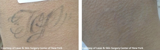 Explore forearm cross tattoo ideas, creative tattoo ideas in Southampton, available at Laser & Skin Surgery Center of New York - Southampton