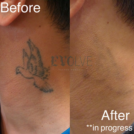 Explore jiu jitsu tattoo ideas, creative tattoo ideas in San Diego, available at Evolve Tattoo Removal