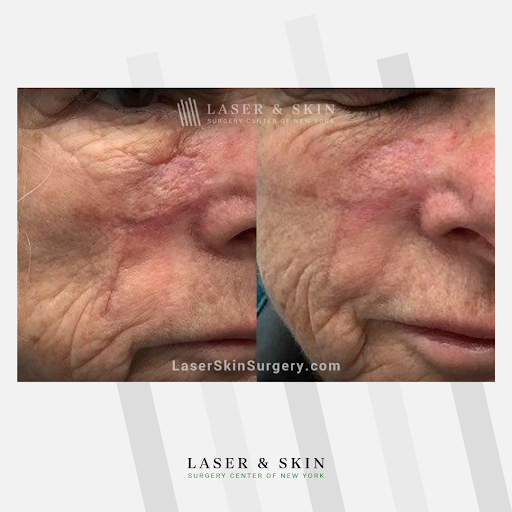 Explore bouquet tattoo ideas, creative tattoo ideas in Southampton, available at Laser & Skin Surgery Center of New York - Southampton