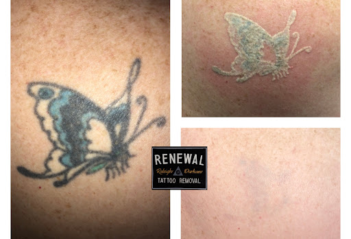 Explore hear no evil tattoo ideas, creative tattoo ideas in Raleigh, available at Renewal Tattoo Removal