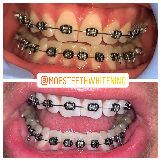 Moe's Teeth Whitening