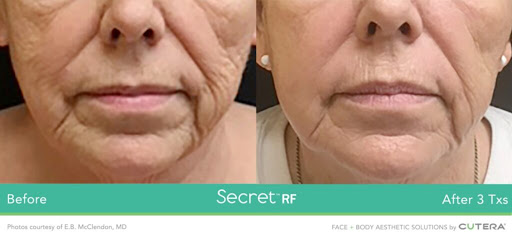 Explore new zealand tattoo ideas, creative tattoo ideas in Clifton Park, available at Capital Skin Medical Spa