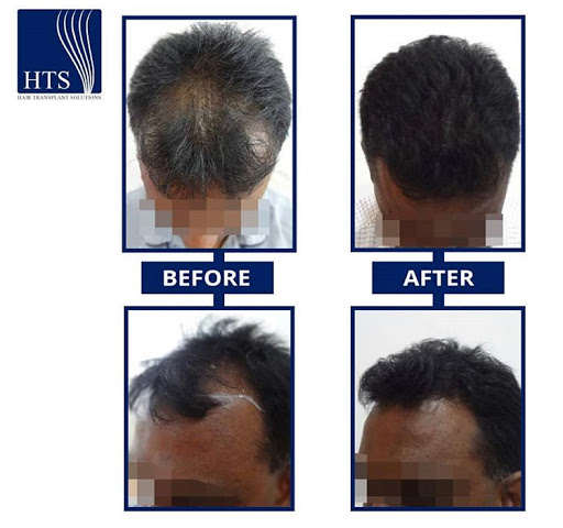 Hair Transplant Solutions