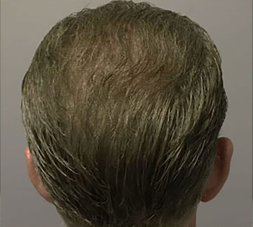 Ziering Medical Hair Restoration Beverly Hills image