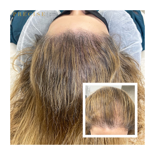 Precise Scalp Micro - Scalp Micropigmentation Service and Training image