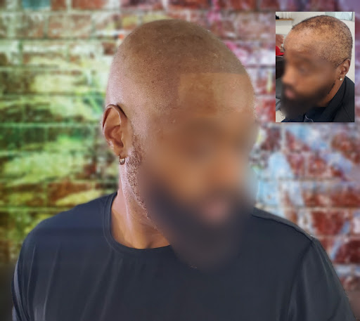 Downey Hair Loss Solutions SMP image
