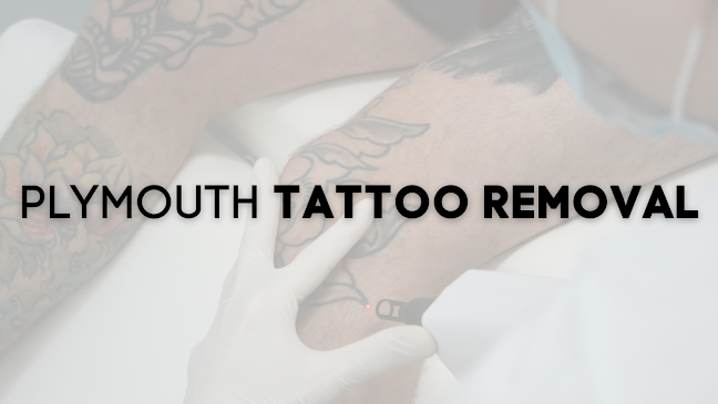 Plymouth Tattoo Removal