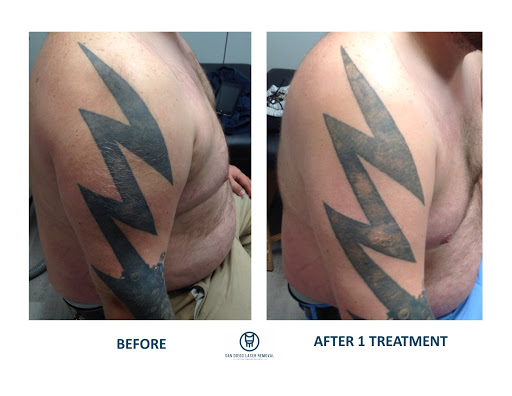 Explore black heart heart tattoo cover up ideas, creative tattoo ideas in San Diego, available at Removery Tattoo Removal & Fading