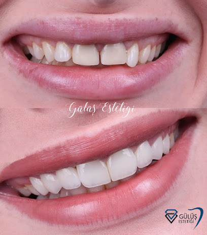 Dental İmplant - Gülüş Tasarımı - Zirkonyum - E-max - Porselen