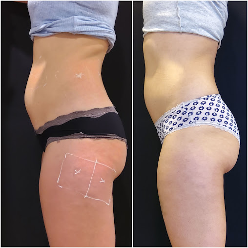 Beautilase - Beautilase