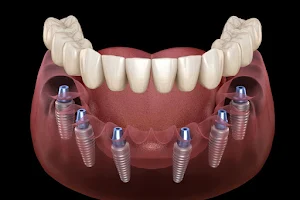 Smart Arches Dental Implants - Bartonsville image