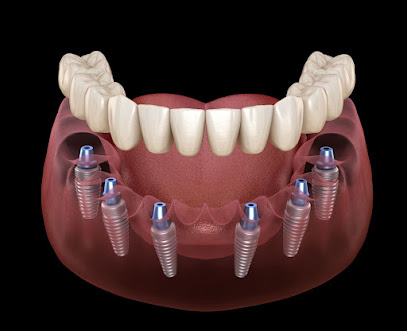 Smart Arches Dental Implants - Bartonsville