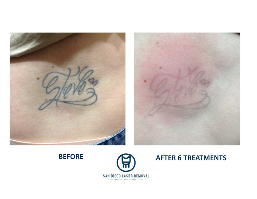 Explore tattoo ideas ribs, creative tattoo ideas in San Diego, available at Removery Tattoo Removal & Fading