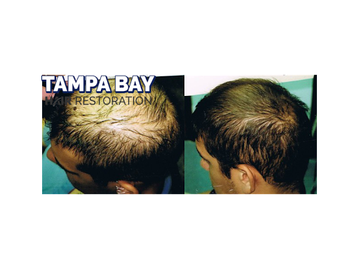 Hair Replacement Service «Tampa Bay Hair Restoration», reviews and photos, 1266 Turner St b, Clearwater, FL 33756, USA