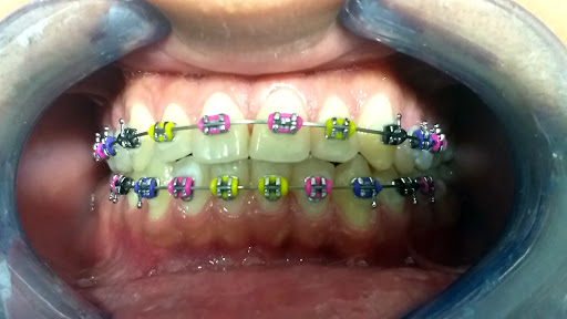 Periodoncista de implantes dentales Chimalhuacán