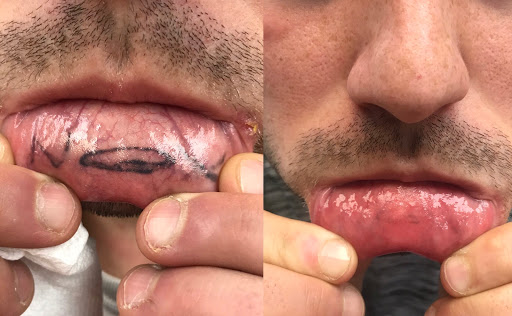 Explore timeless tattoo ideas, creative tattoo ideas in Rochester, available at Renewal Laser Clinic