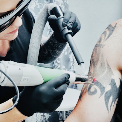 Denton Laser Tattoo Removal