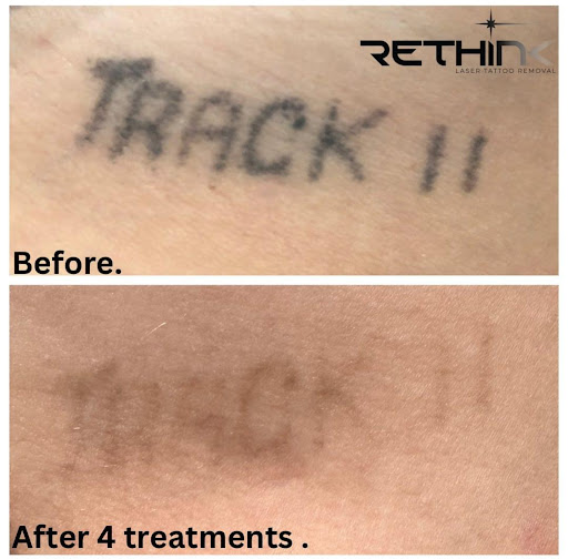 Explore cherry tattoo ideas, creative tattoo ideas in Arlington, available at Rethink Laser Tattoo Removal