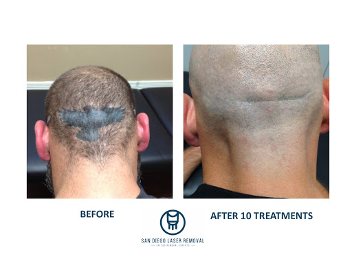 Explore 3 heart tattoo ideas, creative tattoo ideas in San Diego, available at Removery Tattoo Removal & Fading