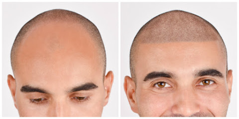 Complete Micropigmentation