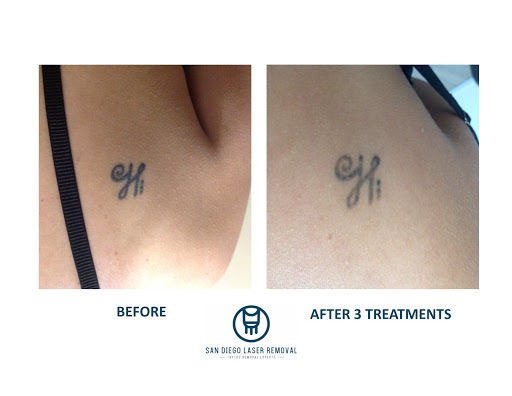 Explore mens cover up tattoo ideas, creative tattoo ideas in San Diego, available at Removery Tattoo Removal & Fading