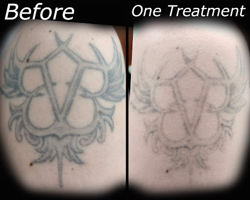 Explore august tattoo ideas, creative tattoo ideas in Brighton, available at Tip of the Spear Laser Esthetics