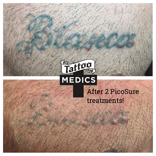 Explore dripping tattoo ideas, creative tattoo ideas in Providence, available at TattooMedics Laser Tattoo Removal