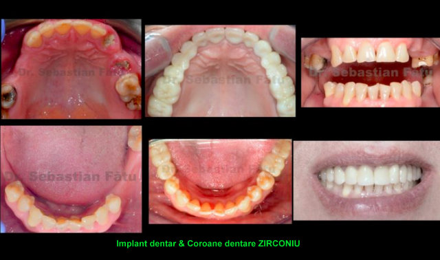 DentaImplant - Implant dentar Bucuresti, Fast&Fixed, implant dentar intr-o zi, Proteza pe Implant - Dentist