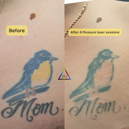 Explore twin miscarriage tattoo ideas, creative tattoo ideas in New York, available at Ag2g Laser Tattoo Removal & MedSpa