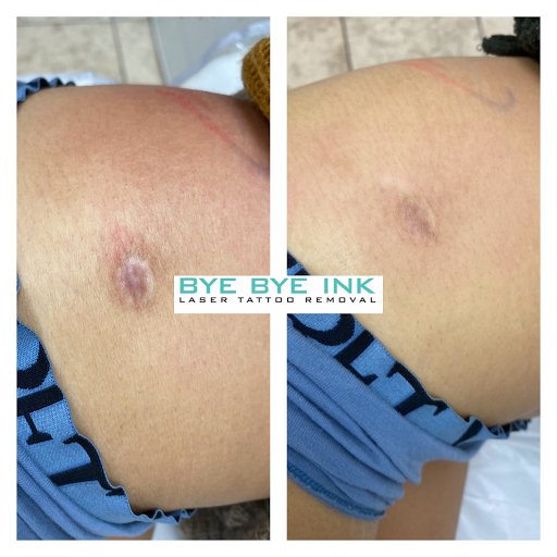 Explore chevy bowtie tattoo ideas, creative tattoo ideas in Middle Village, available at Bye Bye Ink Laser Tattoo Removal