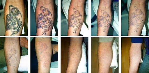Bristol Tattoo Removal Clinic
