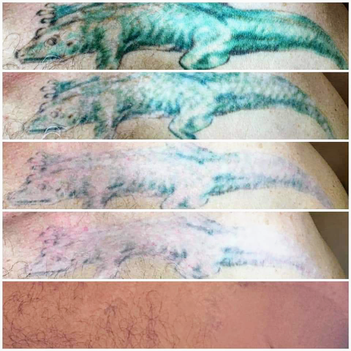 Explore cover up tattoo ideas shoulder, creative tattoo ideas in Pinellas Park, available at St Pete Tattoo Removal