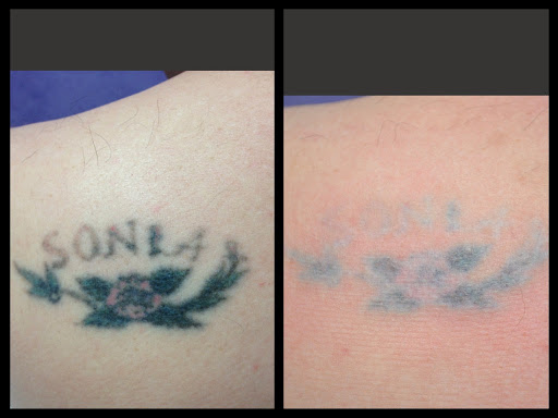 Find thunder tattoo ideas for your next unique tattoo in Colleyville at DFW Tattoo Removal