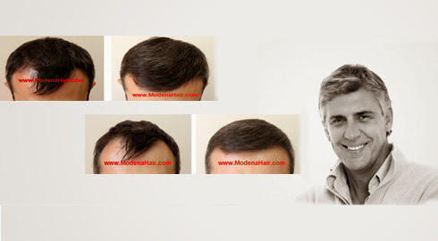 Modena Hair Transplant Institute image