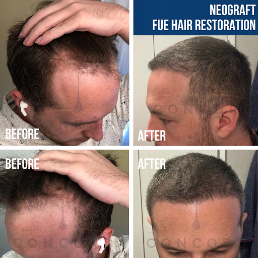 Concord Hair Restoration - Stem Cell