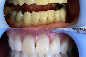 Hey Bright Teeth Whitening image