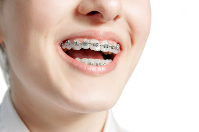 İstanbul Ortodonti Kliniği - Diş Teli - Diş Teli Fiyatları Merkezi