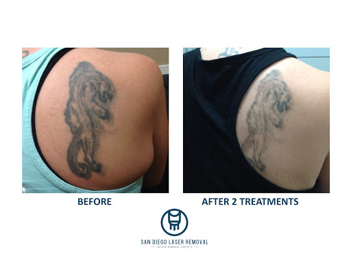 Explore side neck tattoo ideas, creative tattoo ideas in San Diego, available at Removery Tattoo Removal & Fading