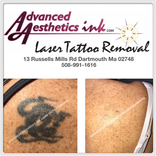 Explore tattoo cover up ideas for dark tattoos, creative tattoo ideas in South Dartmouth, available at Advanced Aesthetics Ink Laser Tattoo Removal