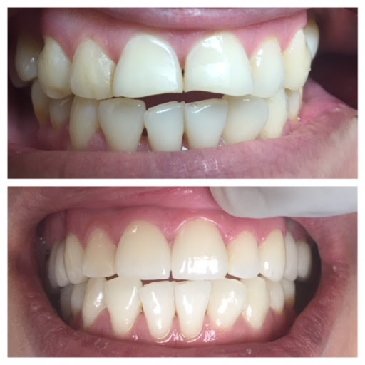 Teeth whitening service Inglewood