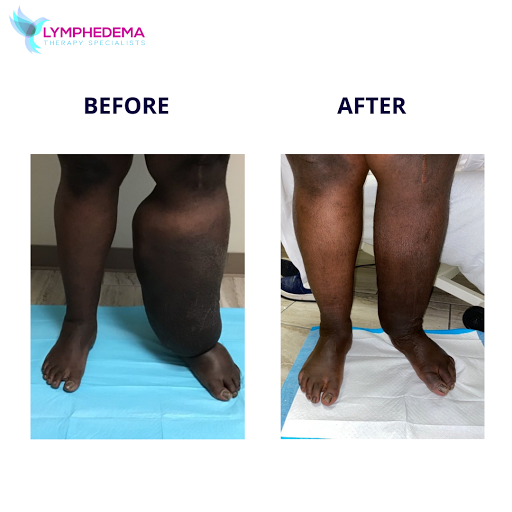 Lymphedema Therapy Specialists | Lymphedema Clinic