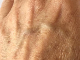 Perfect Beauty Anti-Ageing | Skin Tightening | Plasma Fibroblast | Microneedling