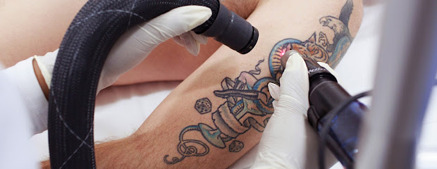 Nanaimo Tattoo Removal