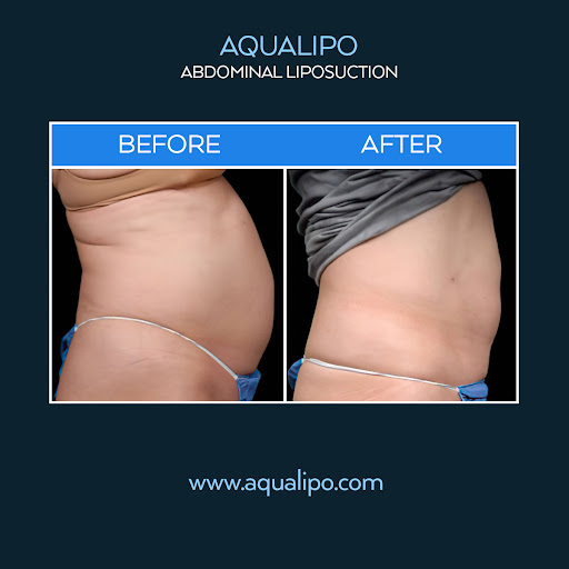 Aqualipo Liposuction Centers