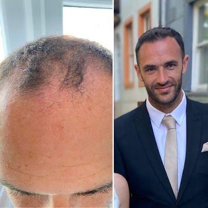 عيادات أفضل لزراعة الشعر - كارديف - Better Hair Transplant Clinics - Cardiff
