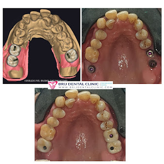 Dr Brijesh Patel’s Brij Dental Clinic & Implant ce - Dr Brijesh Patel’s Brij Dental Clinic & Implant ce