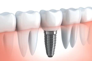 Dentist Near Me Thane - Dr. Karve's Dentech image