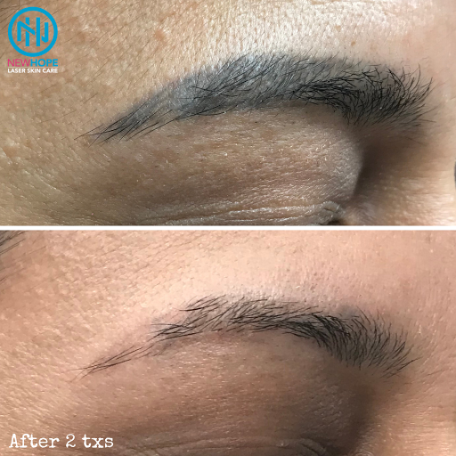 Explore bass tattoos ideas, creative tattoo ideas in Westminster, available at Newhope Laser Skin Care