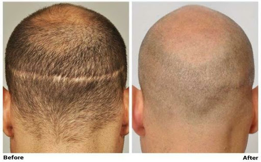 Radiant Aesthetics Clinic - Hair Transplant Surgeon in Mumbai, Fue Hair Transplant in mumbai, prp treatment in Andheri